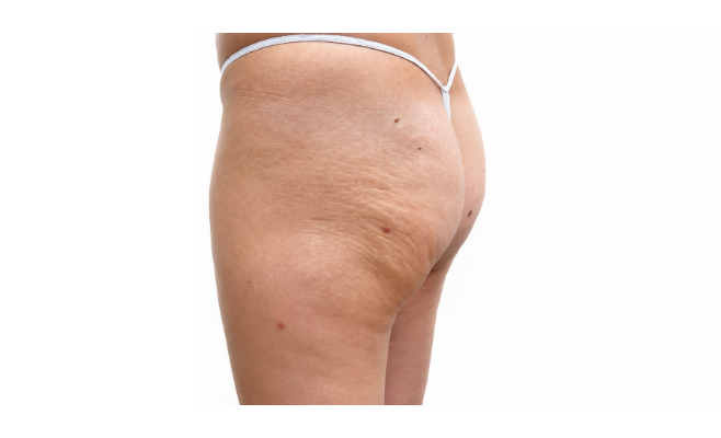 Инъекции полимолочной кислоты